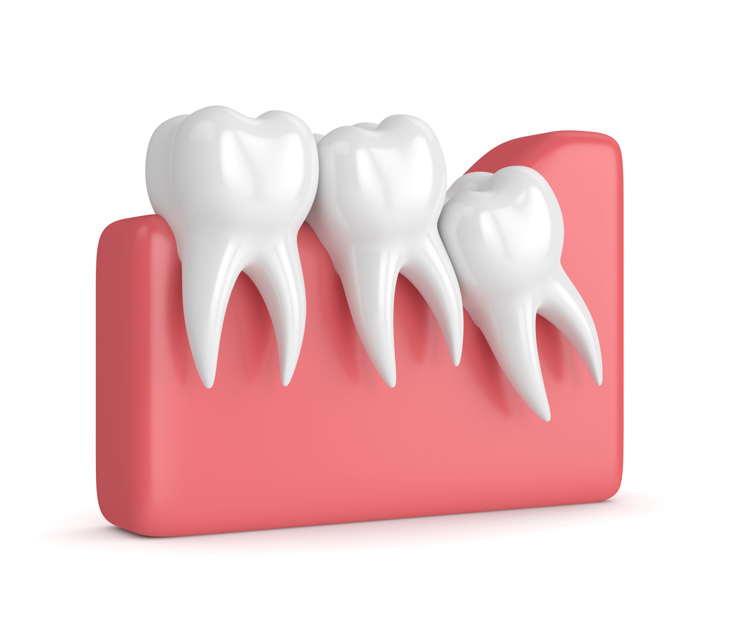 3d Render Of wisdom teeth Crowding