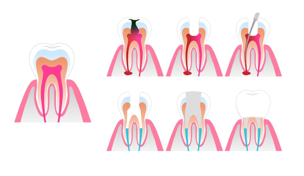Image Demonstrating A Root Canal Procedure