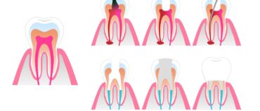Root Canal: All Your Questions Answered