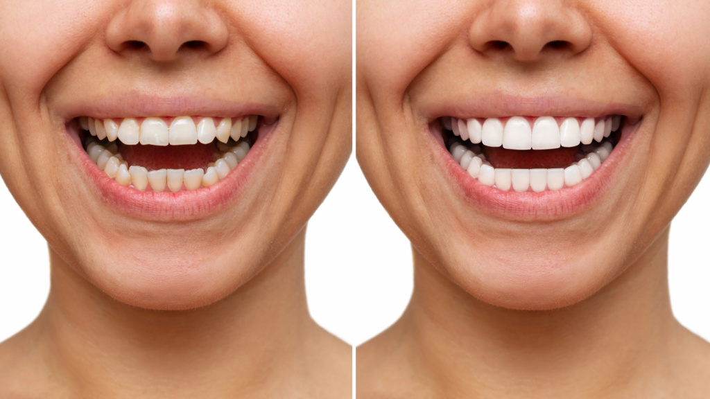 Cropped Shot Of A Young Caucasian Smiling Woman Before And After Veneers Installation