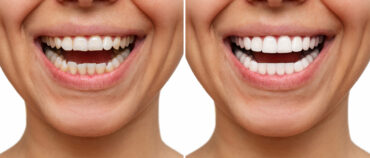 Veneers: What Are They? Are They Right For You?
