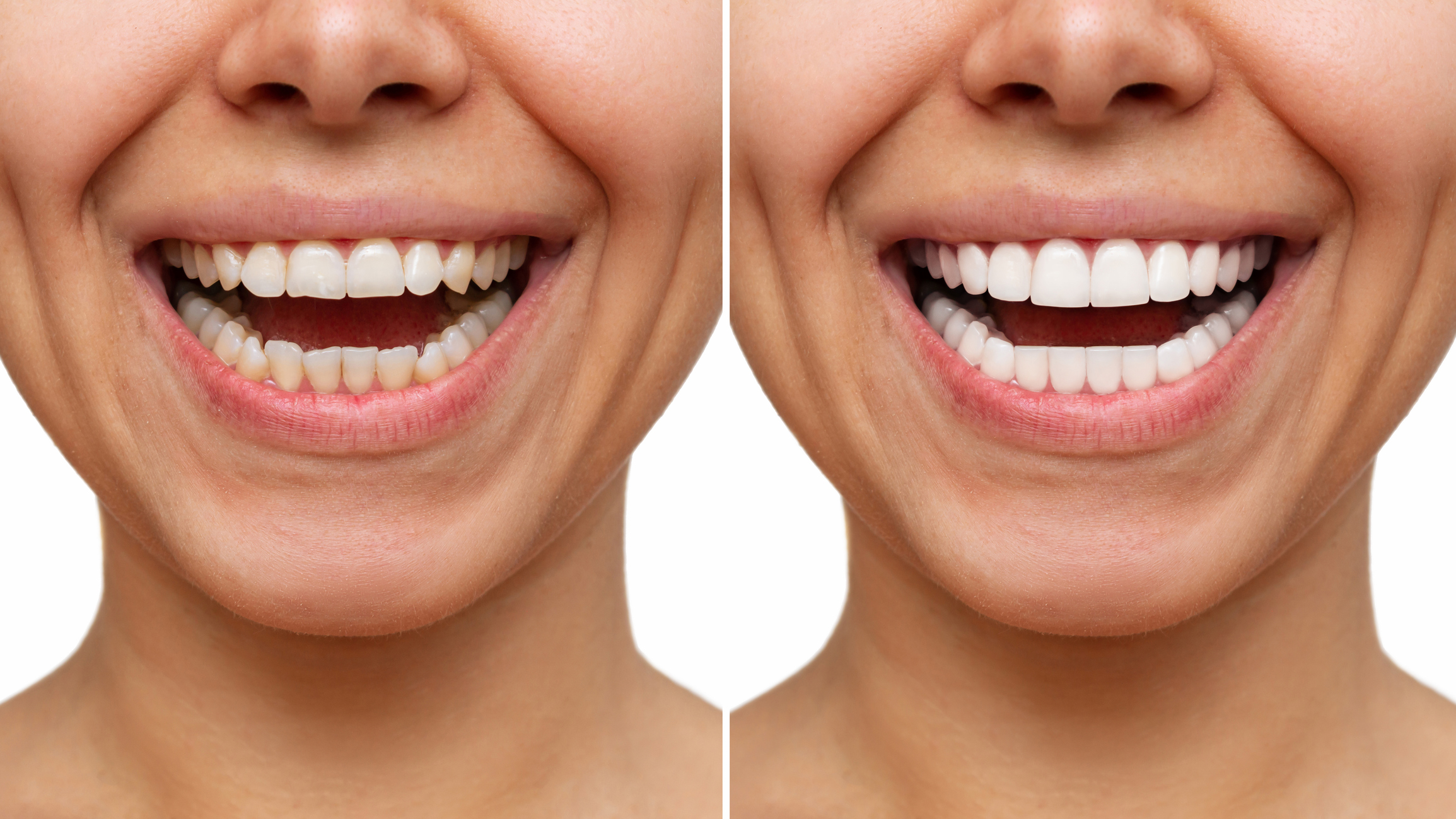Veneers: What Are They? Are They Right For You?