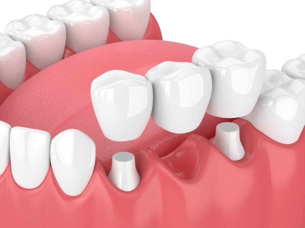 Close Up Image Of A Dental Bridge.