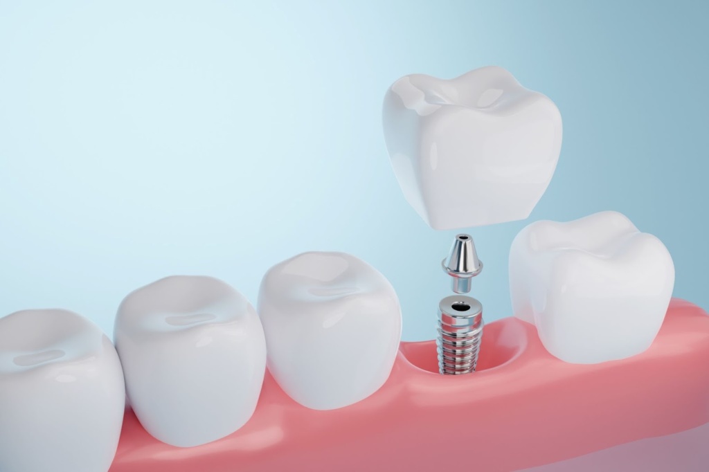 Image Showing A Gum Line And How A Dental Implant Procedure Works
