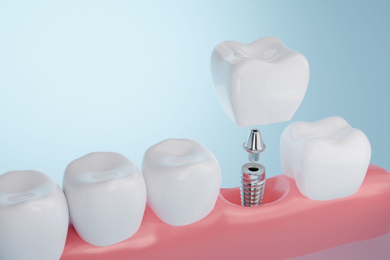 Dental Implants: Everything You Need To Know