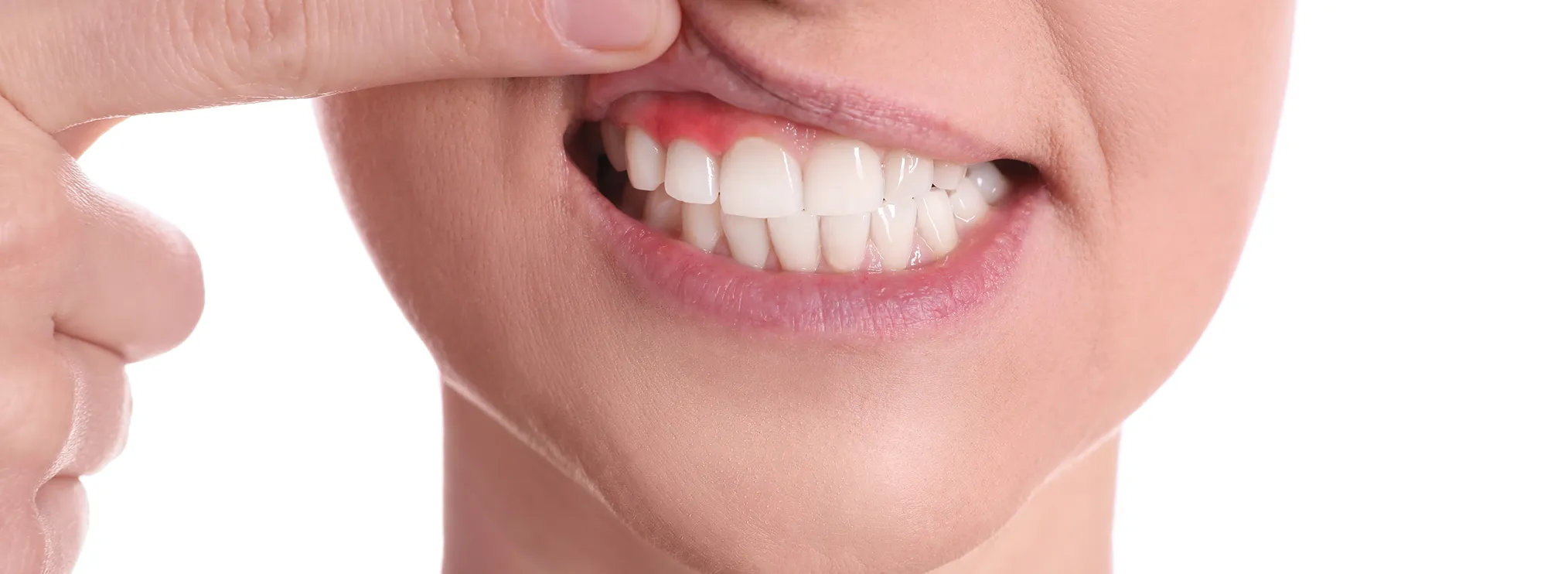 Bleeding Gums@2x