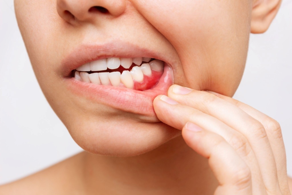 Gingivitis vs Periodontitis
